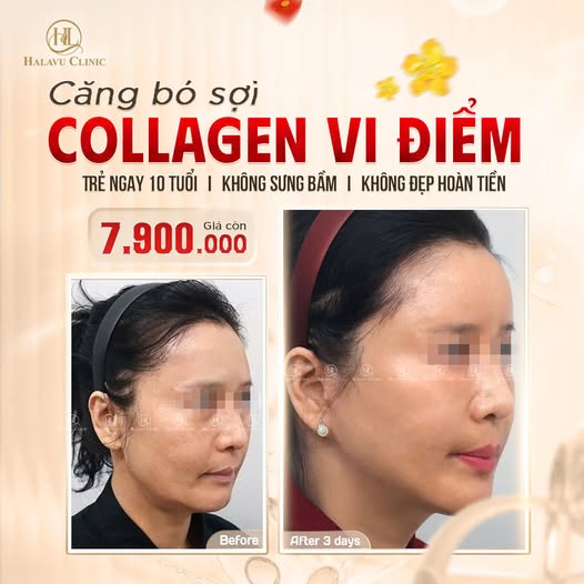 Căng bó sợi Collagen vie điểm 4