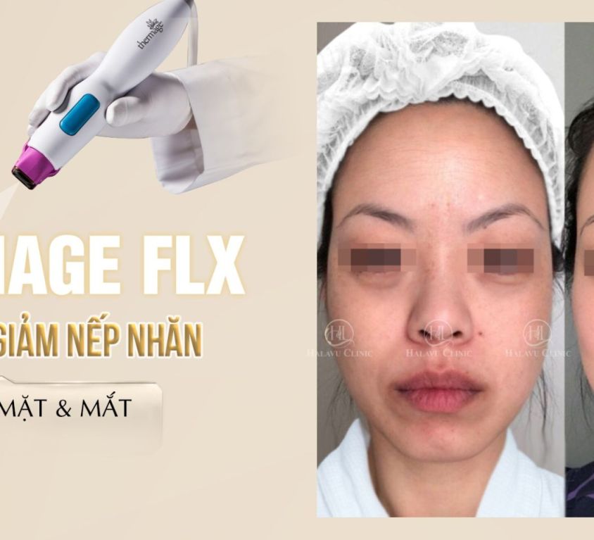 căng da giảm nếp nhăn