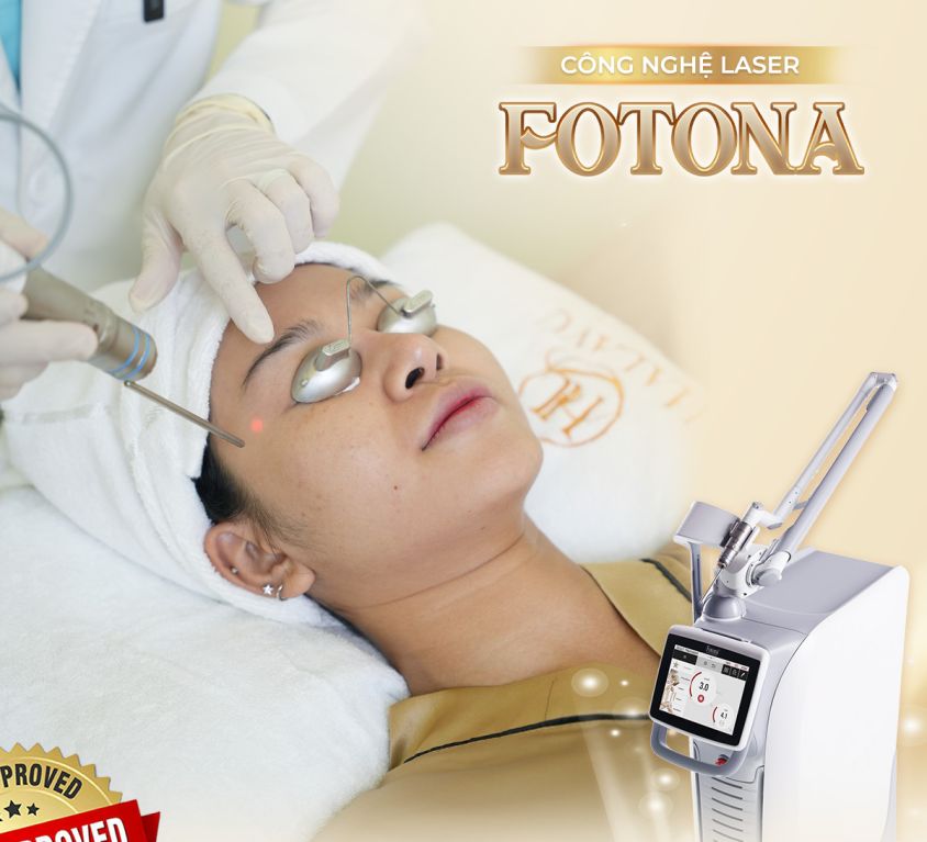 công nghẹ laser