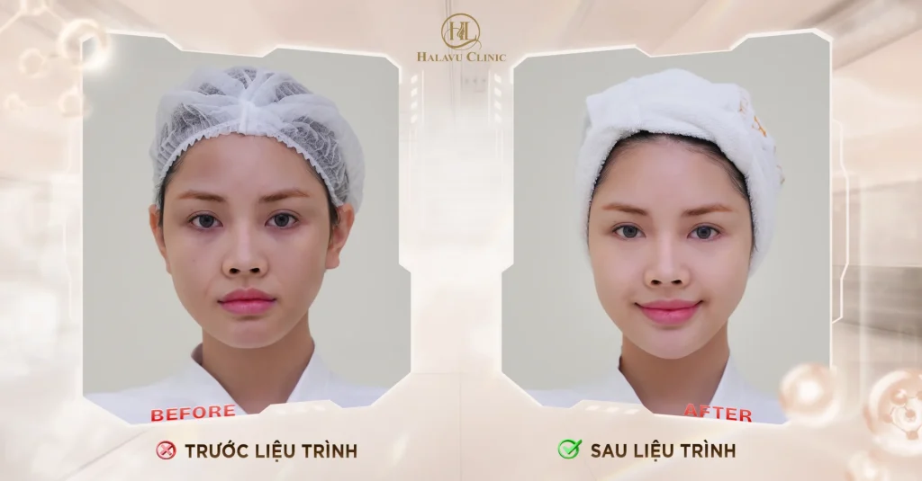 Sau liệu trình - Đan Tiên lấy lại làn da đầy sức sống